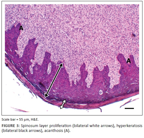 Hyperkeratosis bőr papilloma - Verruca senilis