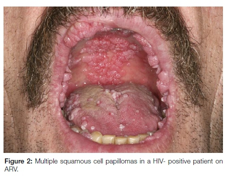 human papillomavirus infection dental)