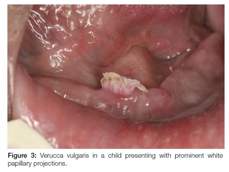 Warts by mouth - Human papillomavirus on gums