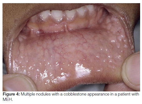 papilloma lesion in mouth