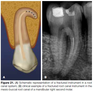 weine endodontic therapy pdf 32