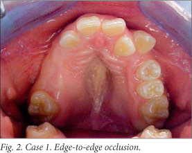 JCDR - Rubinstein Taybi Syndrome, Oro-facio-dental findings