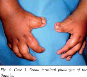 Broad thumbs and broad hallux: the hallmarks for the Rubinstein