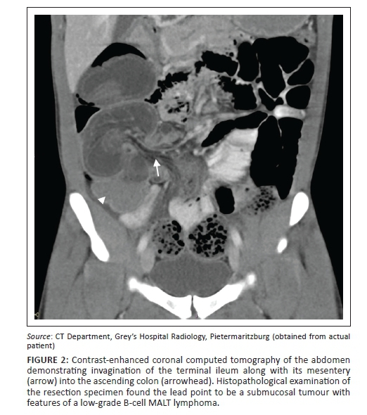 Adult intussusception An unlikely diagnosis