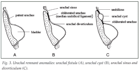 Patent urachus