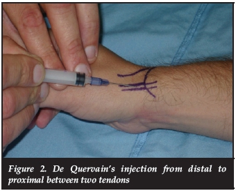 De quervain's tenosynovitis corticosteroid injection