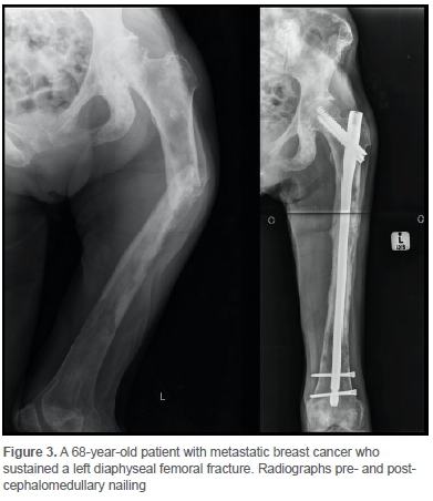 The surgical management of metastatic lesions of the femur