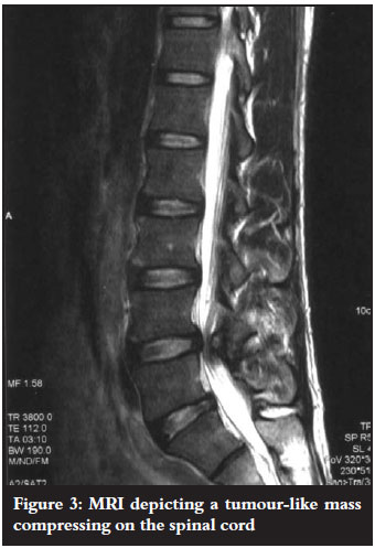 osteoartrita claviculei a doua vertebră cervicală