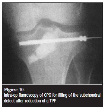 Tibial Plateau Fracture Future Complications