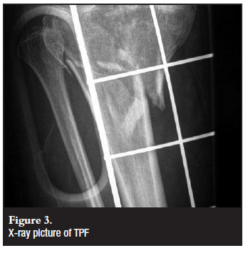 Tibial Plateau Fracture Future Complications