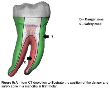 Dentine thicknesses of first molar roots: A review of the literature ...