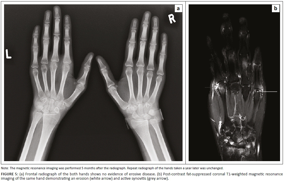 The role of imaging in rheumatoid arthritis