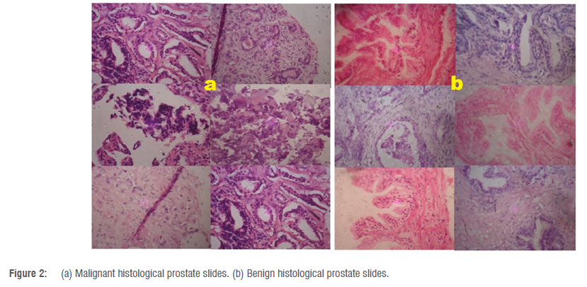 Artificial intelligence-assisted diagnosis of prostate cancer based on ...