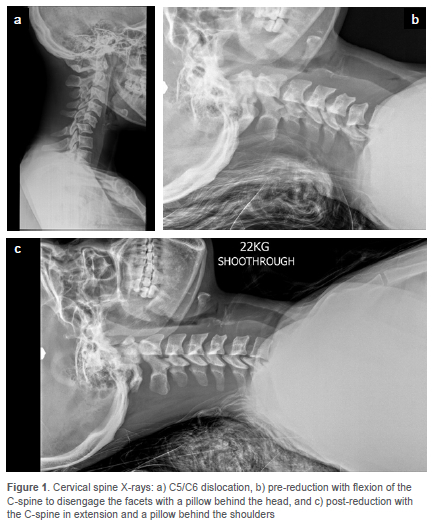 The neurological outcomes of patients with cervical spinal cord injury ...